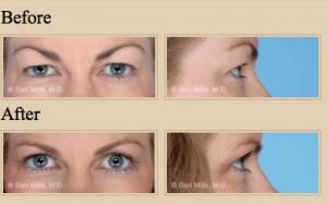 blepharoplasty-before-after