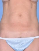 Body Contouring Orange County